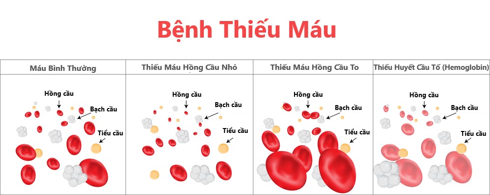 phân biệt thiếu máu hồng cầu nhỏ và hồng cầu to